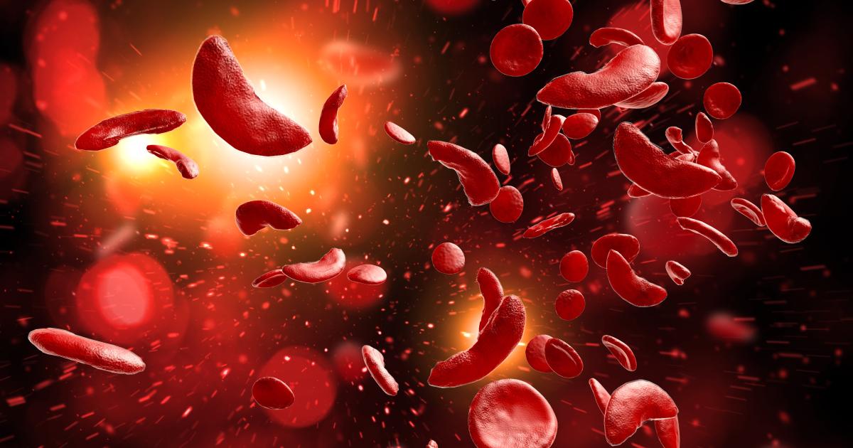 « La drépanocytose n’est pas qu’une maladie de noirs »