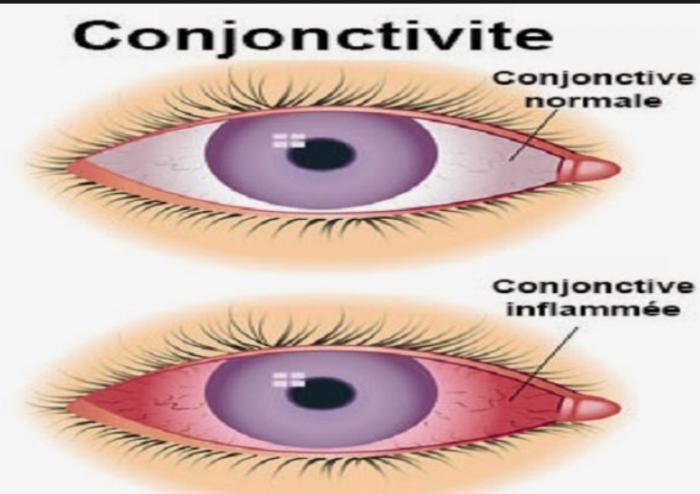 18 000 personnes ont été touchées par la conjonctivite