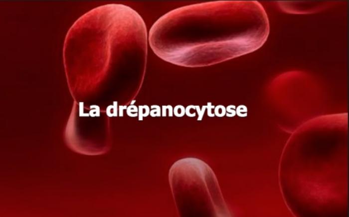 19 juin : journée mondiale de la drépanocytose