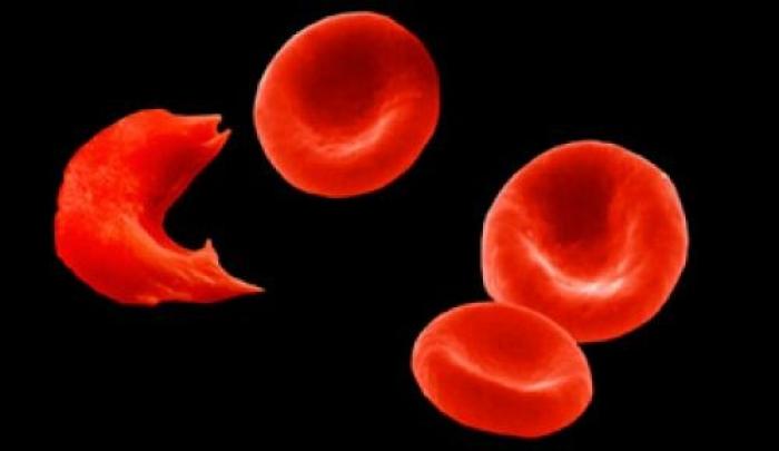 Drépanocytose : une journée pour prendre conscience