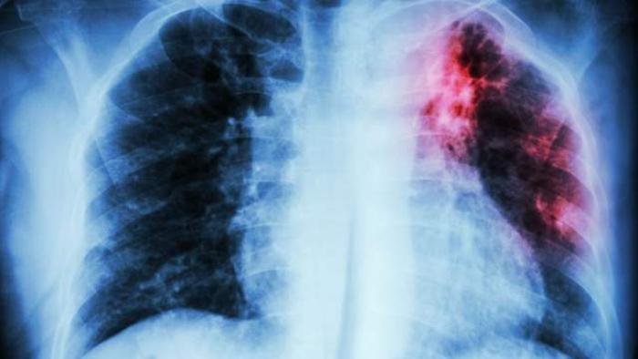 Journée mondiale contre la tuberculose