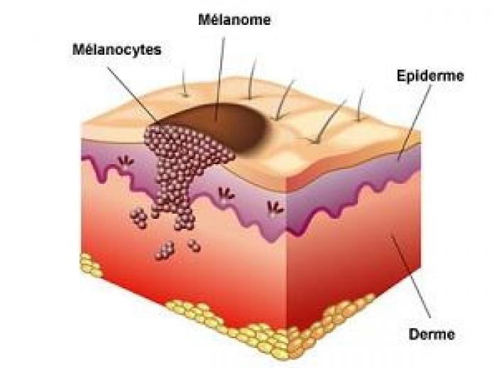 Le mélanome cutané, un cancer encore peu connu