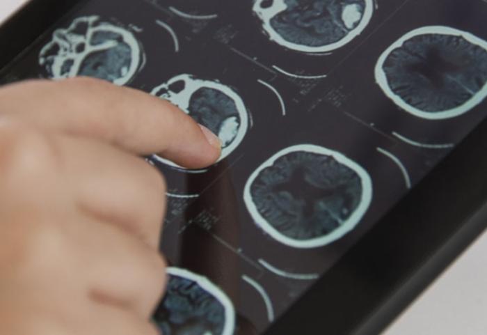 Les premières assises régionales sur les maladies neurodégénératives se tiennent ce vendredi