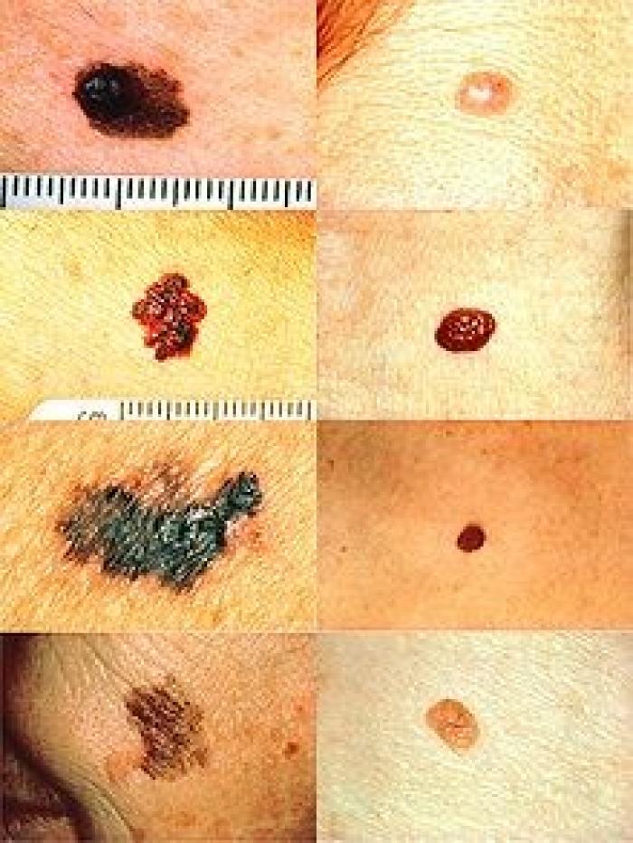 Une journée de dépistage des cancers de la peau