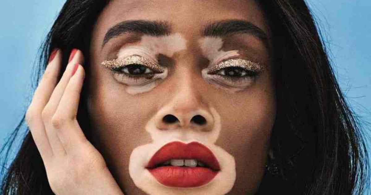     





Une journée dédiée au vitiligo 




