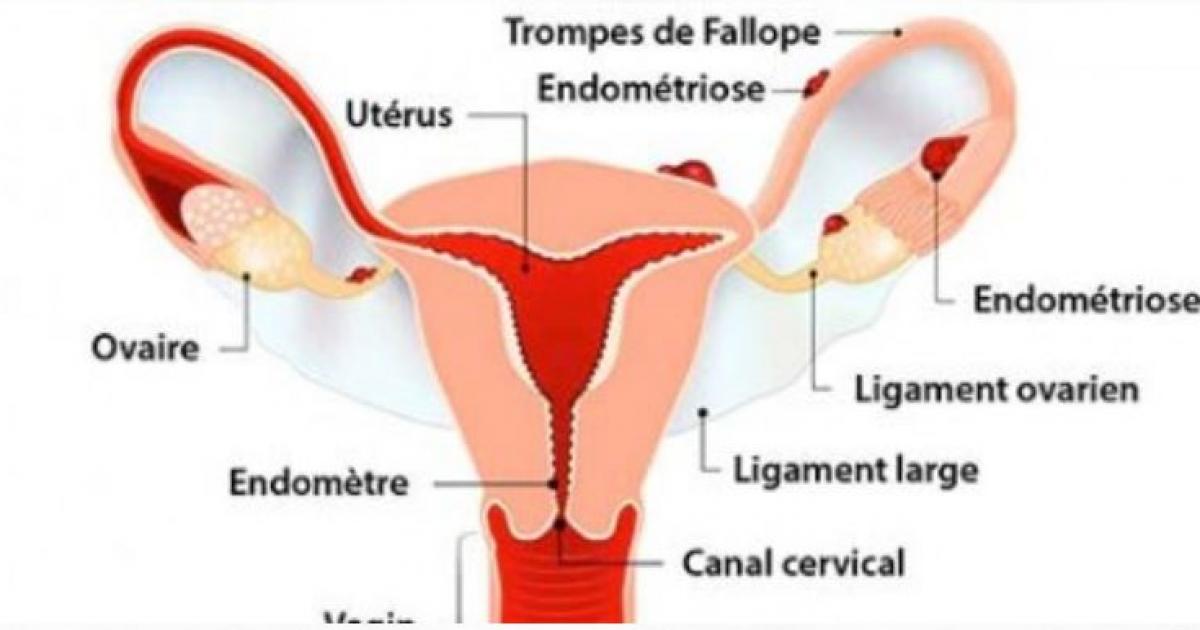     





Une stratégie nationale de lutte contre l'endométriose




