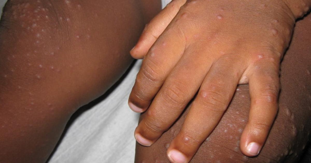 Le syndrome pieds-mains-bouche circule et touche de nombreux enfants en Martinique