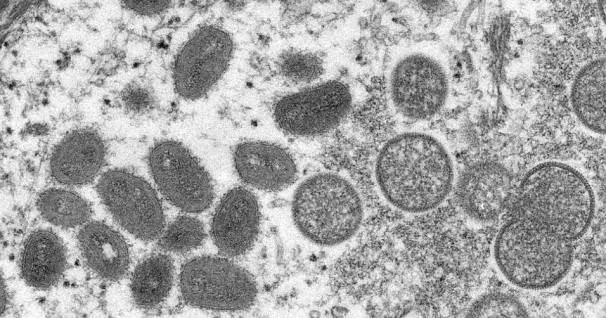 Deux cas suspects de variole du singe en Guyane