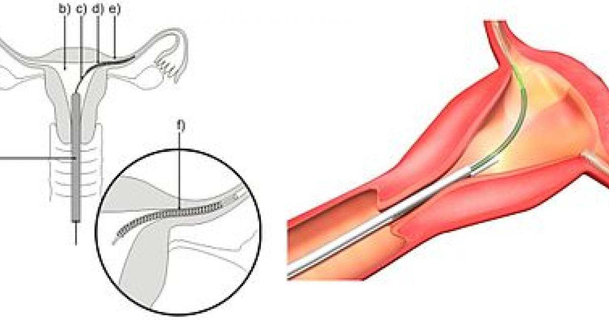 « Certaines femmes étaient en souffrance avec des implants Essure »