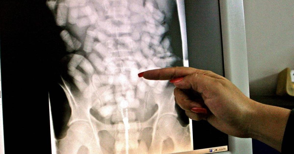 Un voyageur Guyanais avec 200 ovules de cocaïne dans le corps